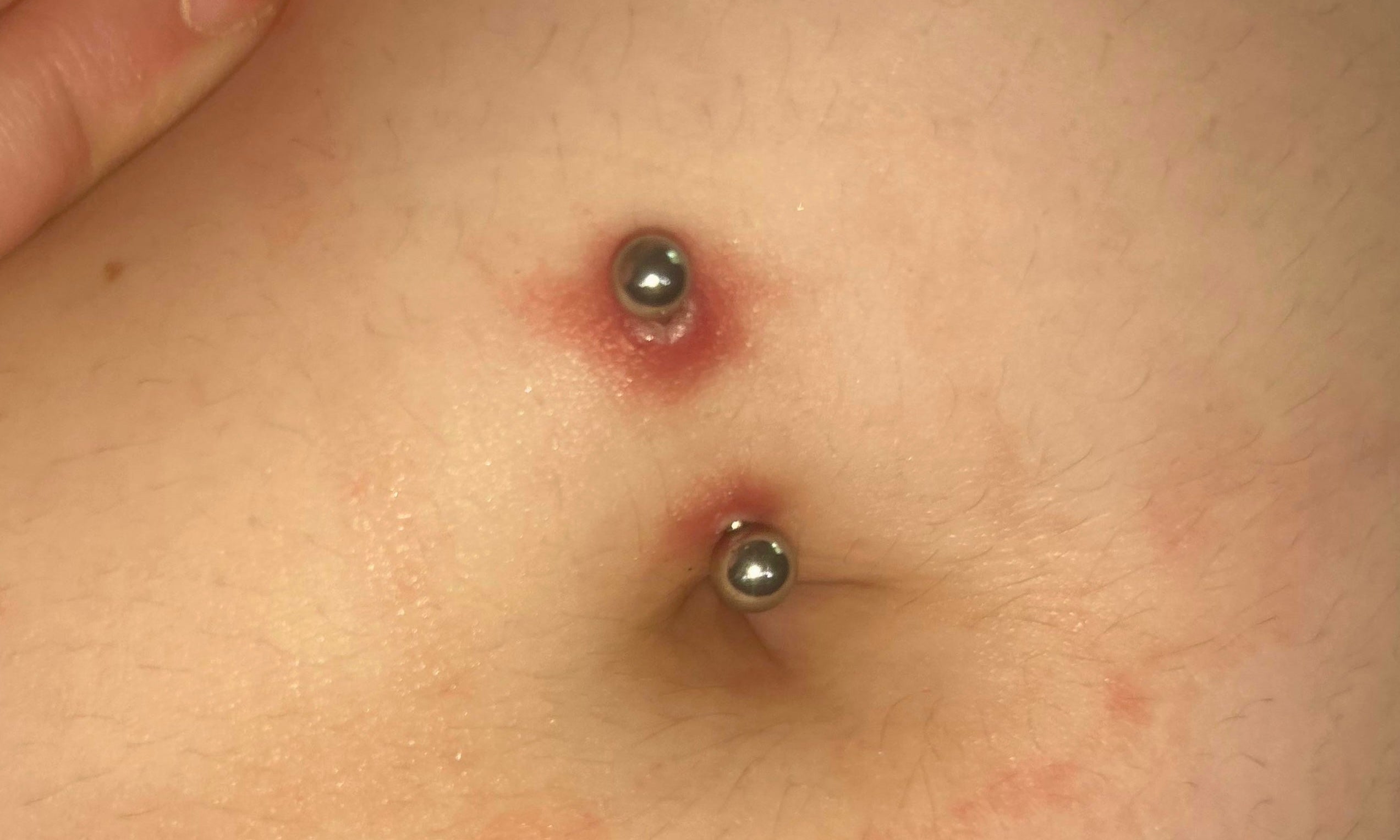 Infezione o allergia al piercing?