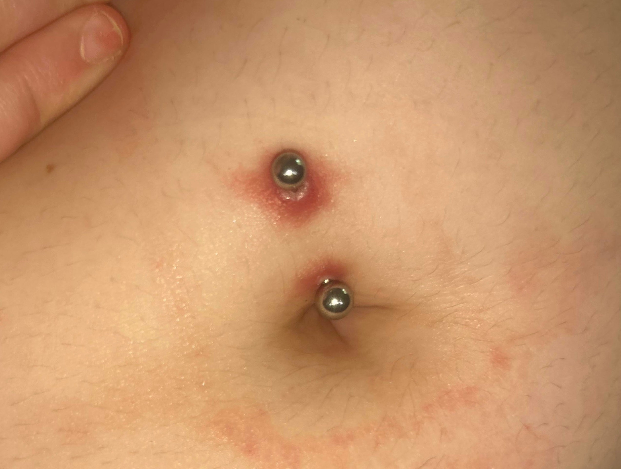 Infezione o allergia al piercing?
