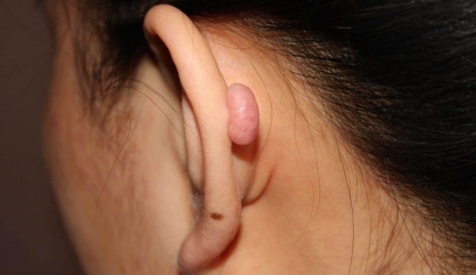 Perchè ho una bollicina accanto al piercing?