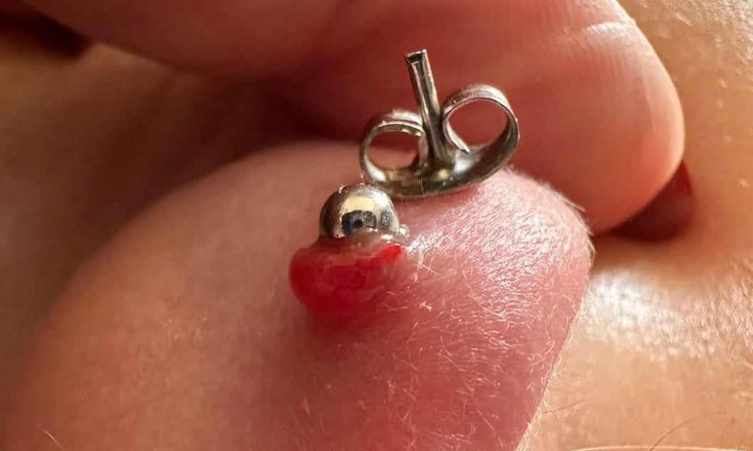 Granuloma o cheloide?