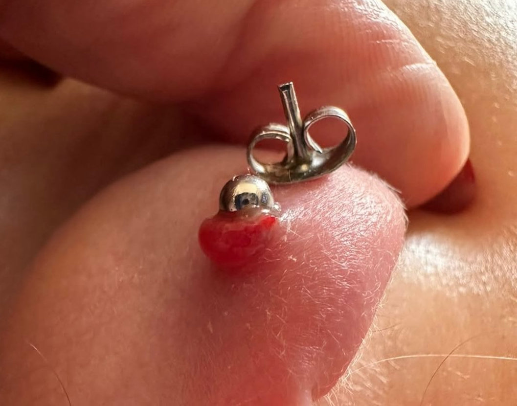Granuloma o cheloide?